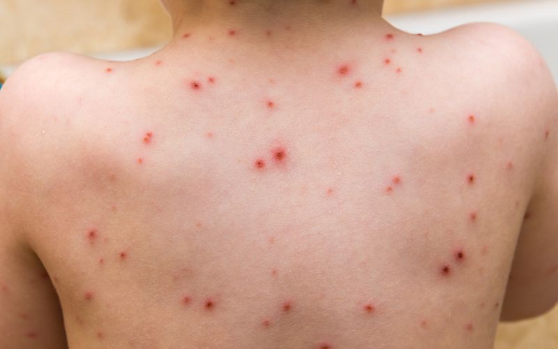 tuân thủ lịch tiêm cho trẻ phòng bệnh thủy đậu