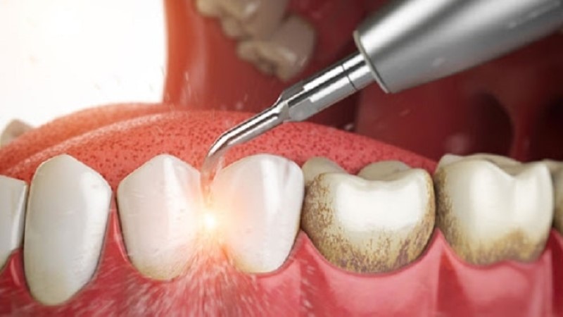 Các phương pháp loại bỏ cao răng