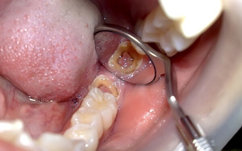 Điều trị răng sâu lỗ to