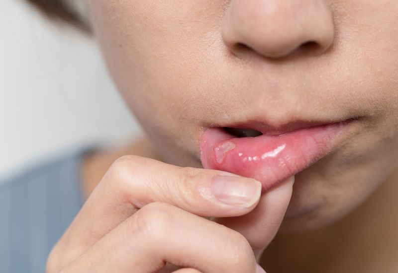 Nhiệt miệng là tình trạng màng nhầy khoang miệng (màng nhầy bao phủ các khu vực môi, má trong, nướu, mặt dưới lưỡi…) xuất hiện các vết loét.