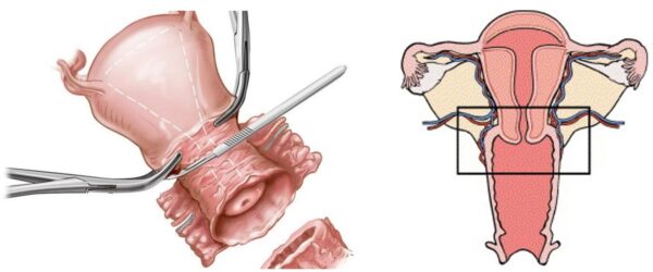 Bệnh ung thư cổ tử cung đã và đang gây nên những hậu quả đáng tiếc cho phụ nữ.