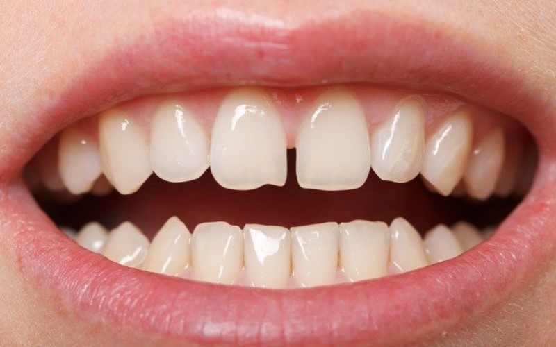 Tìm hiểu trám răng cửa bị sâu có đau không?