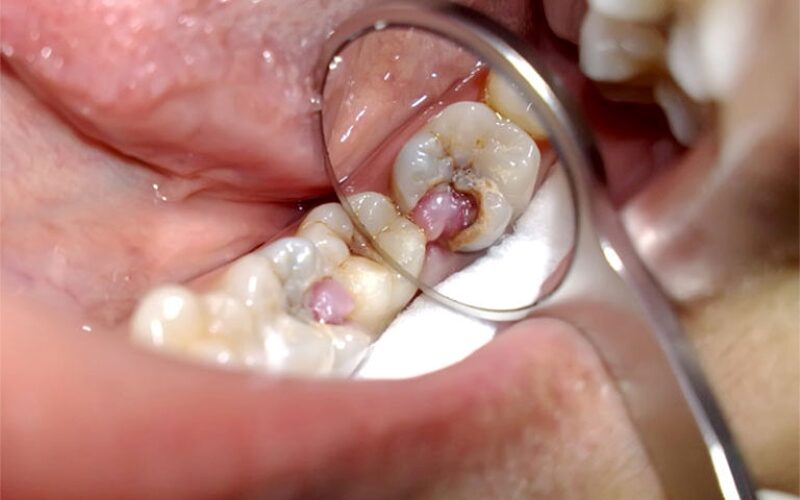Điều trị trẻ em sâu răng hàm