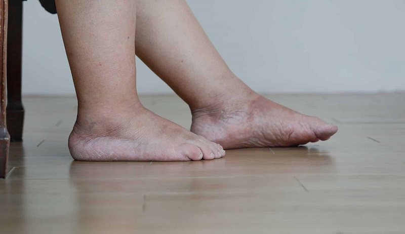 tại sao người bị ung thư giai đoạn cuối hay bị phù chân