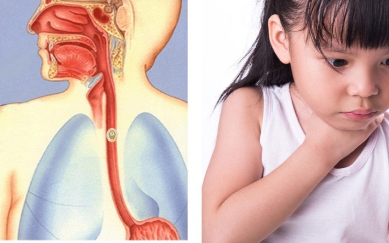 Tình trạng hóc dị vật đường thở