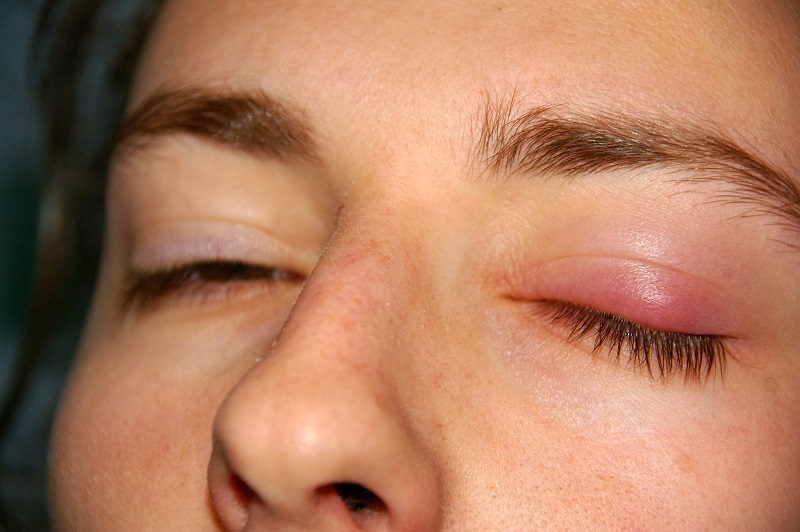 các bệnh về mặt dùng oflovid để điều trị