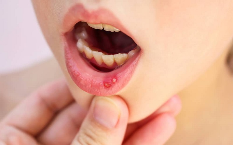 nhiệt miệng ở trẻ nhỏ