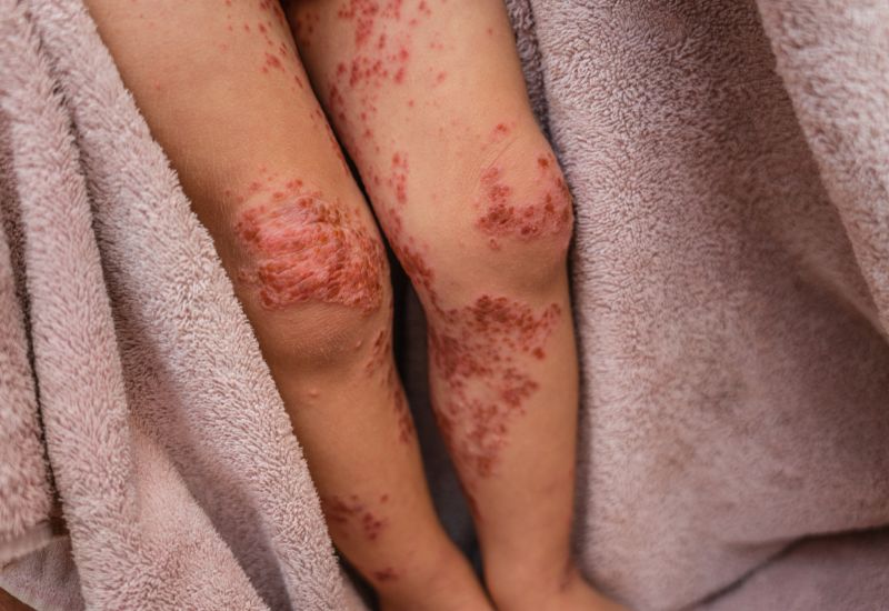 Mới xuất hiện, tổn thương da chỉ là các ban đỏ; theo thời gian chúng phát triển thành các phỏng nước chứa dịch bên trong.