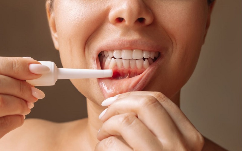 cách dùng thuốc bôi nhiệt miệng