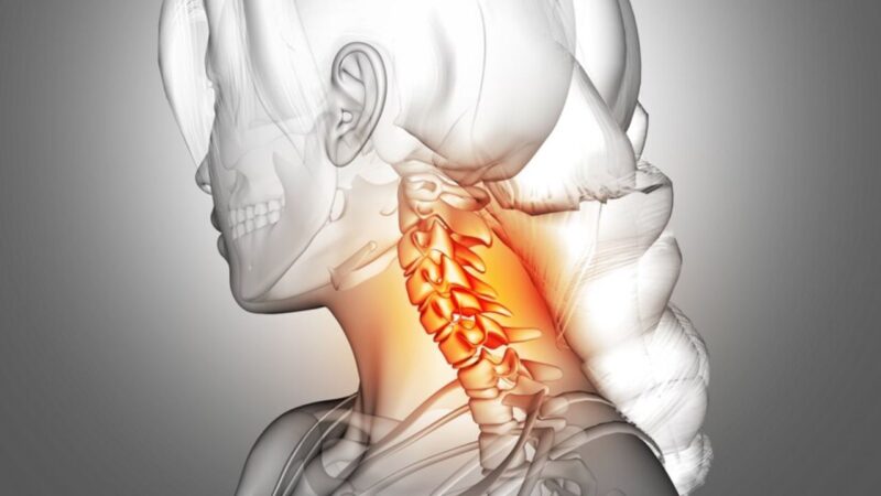 Hẹp lỗ liên hợp cột sống cổ là tình trạng thu hẹp đường ra của rễ thần kinh cổ do bệnh thoái hóa cột sống cổ