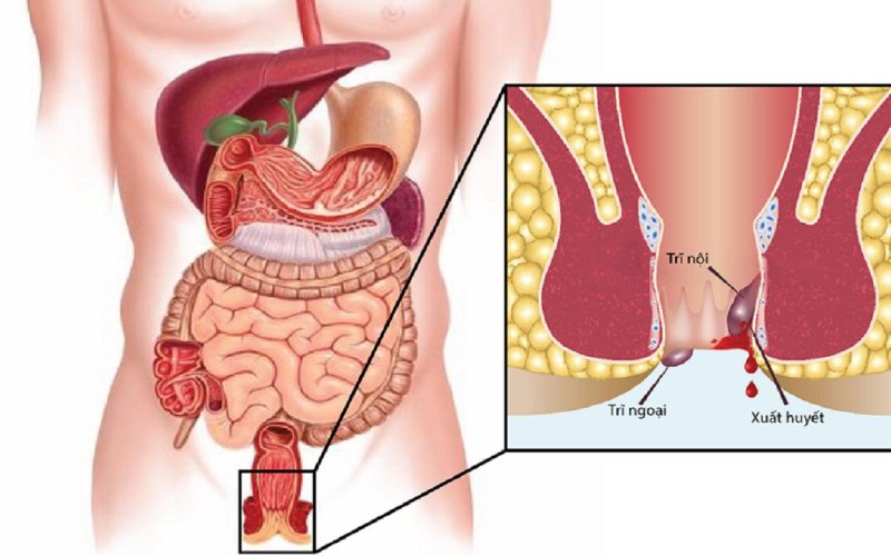biểu hiện của bệnh trĩ