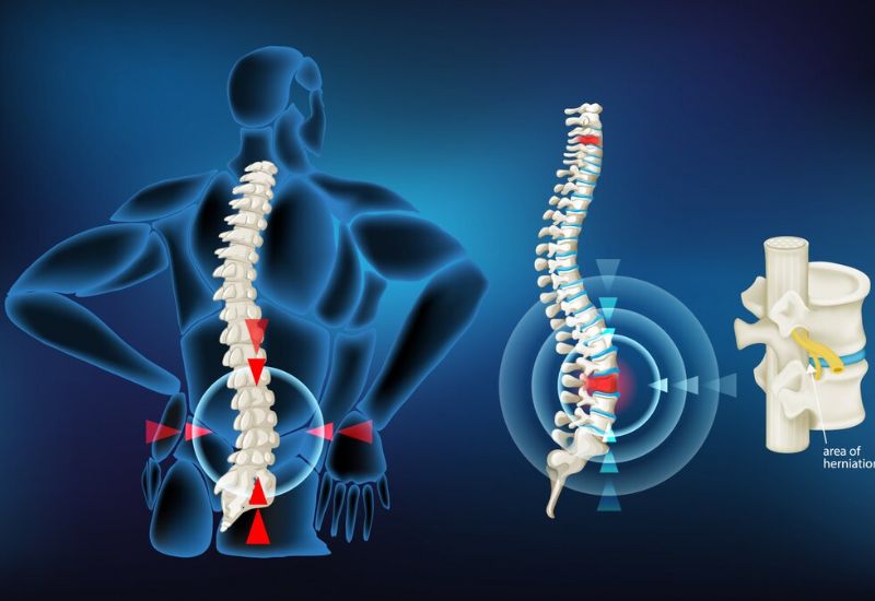 Phẫu thuật thay đĩa đệm cột sống thắt lưng khi tổn thương nghiêm trọng