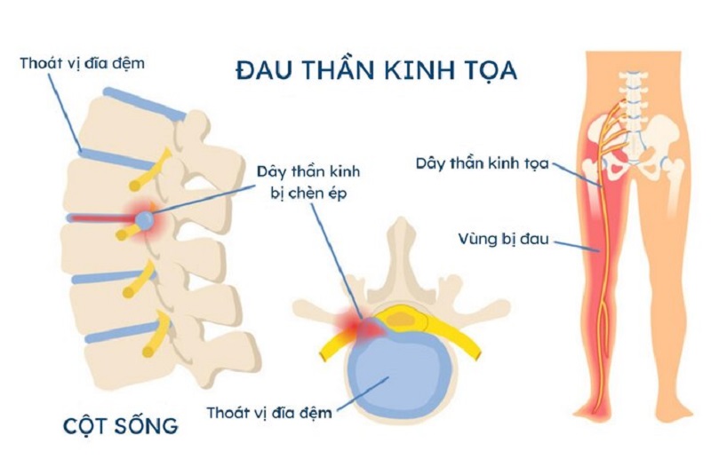 đau thần kinh tọa là gì