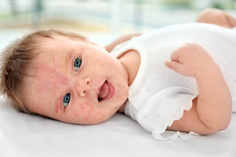 Thận trọng các trường hợp dị ứng với sữa