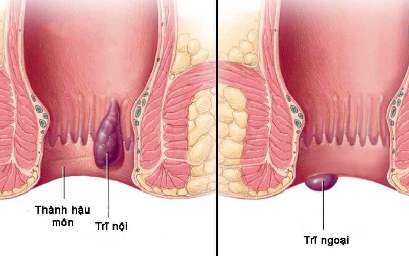 Trĩ nội và trĩ ngoại - trĩ bệnh học