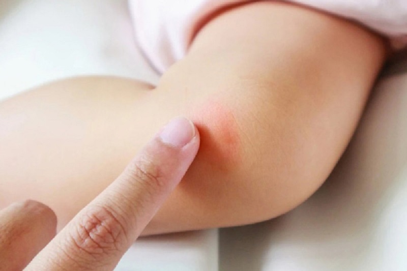 thuốc bôi muỗi đốt