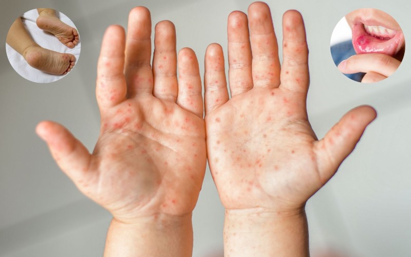 ai có thể dùng kem bôi subạc