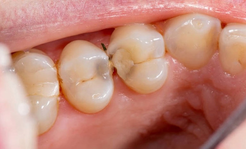 Biểu hiện bé sâu răng sữa