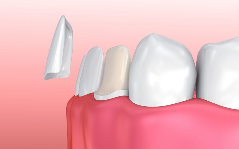 Dán sứ veneer