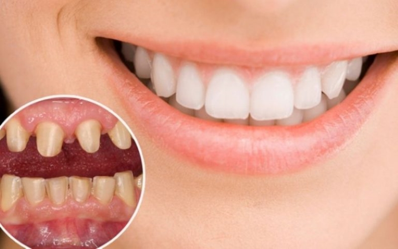 Quá trình bọc răng sứ nguyên hàm