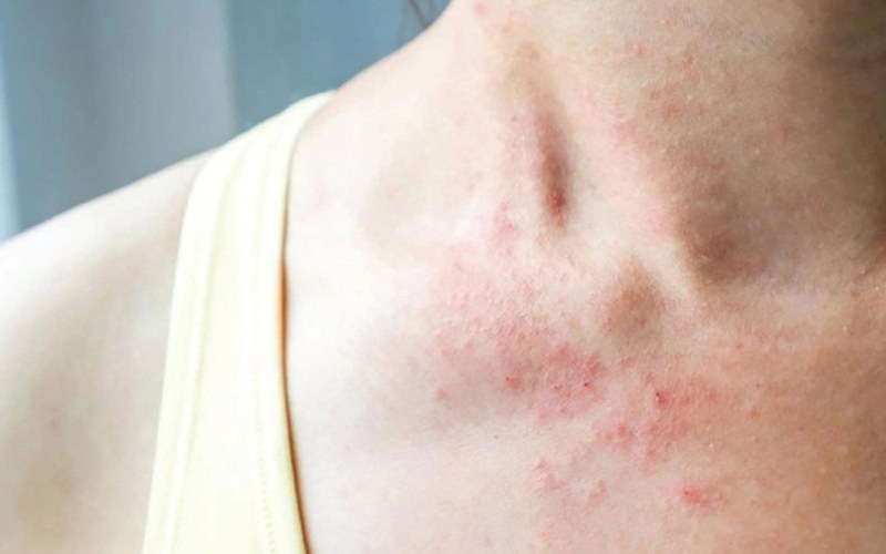 thuốc telfast điều trị dị ứng