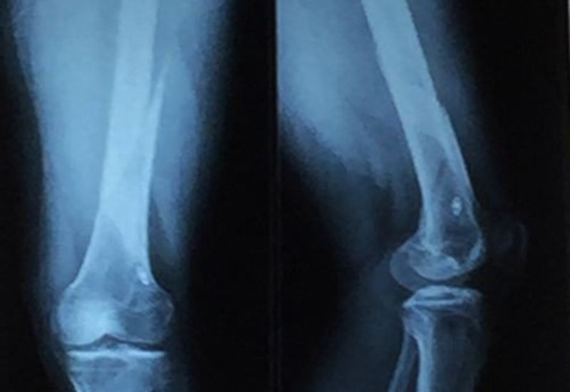 chẩn đoán trật khớp gối