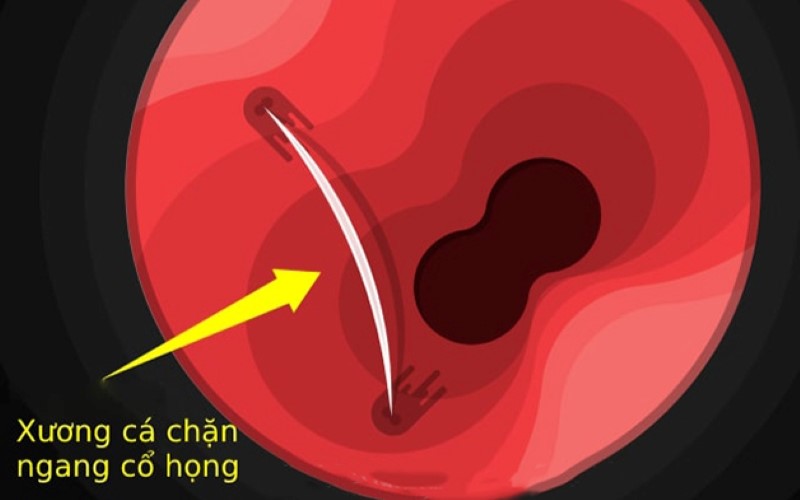 hóc xương