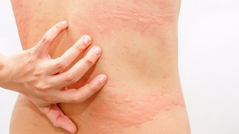 Nguyên nhân và dấu hiệu dị ứng cần điều trị bằng Lorastad