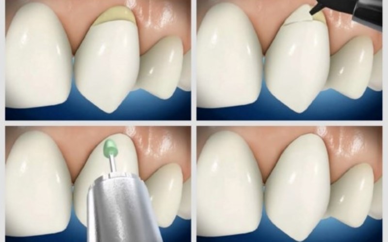 Quá trình thực hiện hàn cổ răng