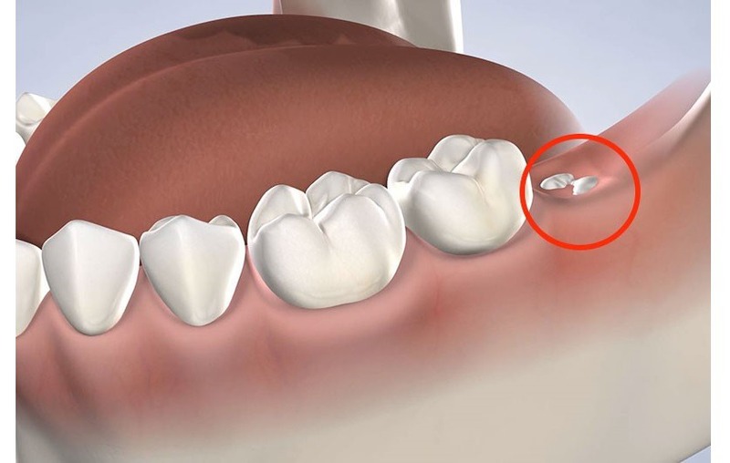 tư vấn khi nào nhổ răng khôn