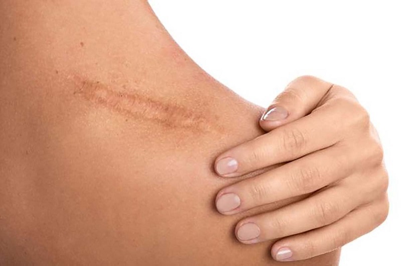 Tình trạng sẹo gây mất thẩm mỹ, khiến người bệnh lo lắng và ảnh hưởng đến sức khỏe.