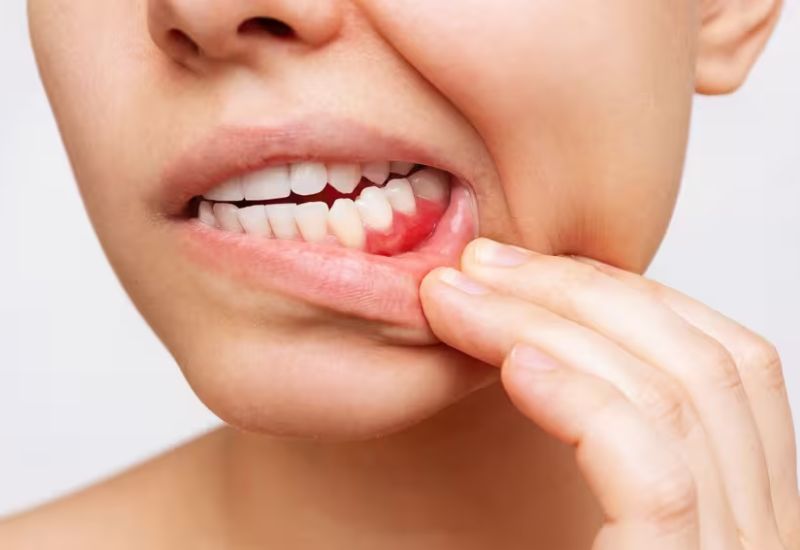 Tuân thủ liều lượng và thời gian sử dụng Naphacogyl