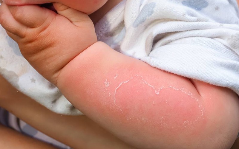 trẻ bị bỏng phải làm sao