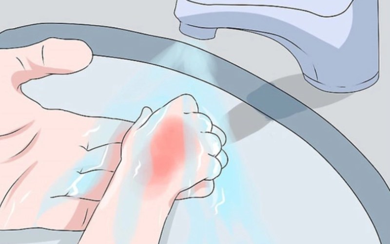 điều trị bỏng ở trẻ em