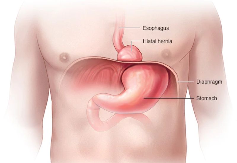 Các bệnh lý gây nuốt nghẹn không phải do trào ngược dạ dày - thực quản