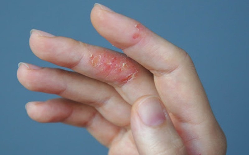 thuốc Fucicort có tác dụng gì