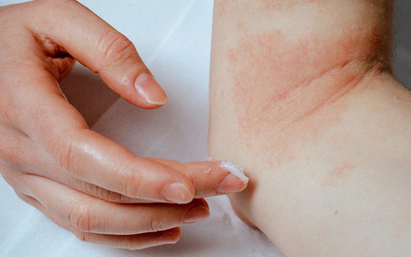 liều lượng và cách dùng thuốc bôi da Fucicort