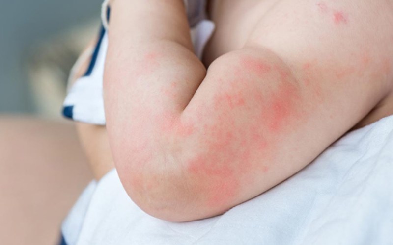 thuốc Fucicort có gây tác dụng phụ không