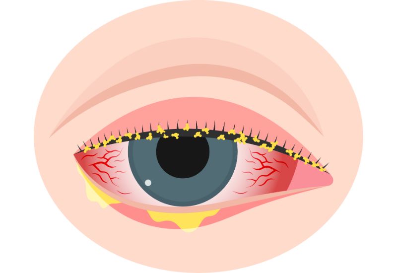 Trong một số trường hợp, mắt có thể tiết nhiều mủ, đặc biệt là vào buổi sáng, khi ngủ dậy. 