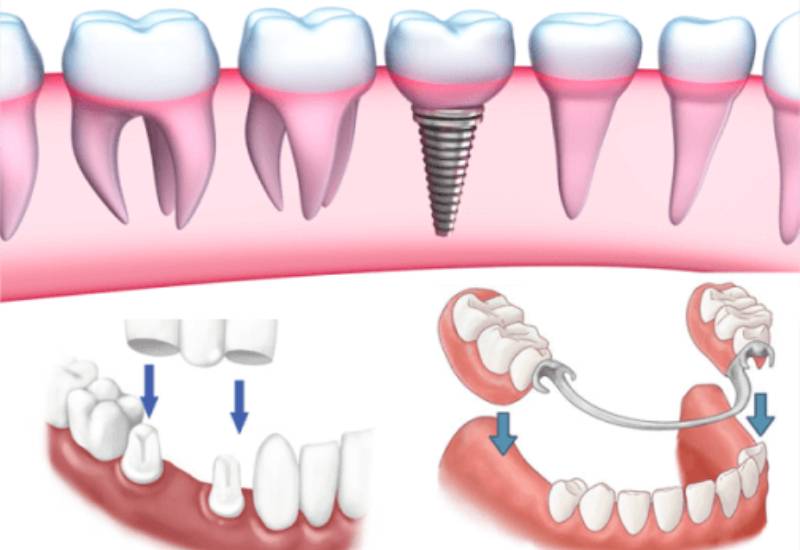 hỏi đáp trồng răng hàm có đau không