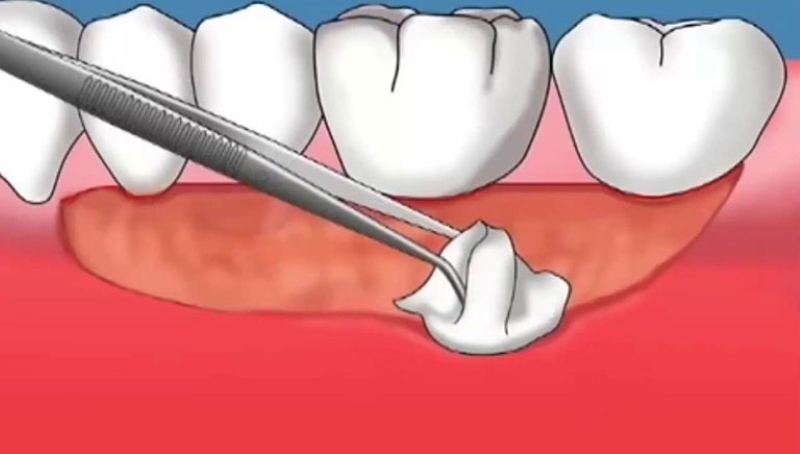 Biểu hiện tụt lợi răng lung lay