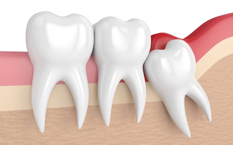 Tình trạng viêm lợi răng số 8