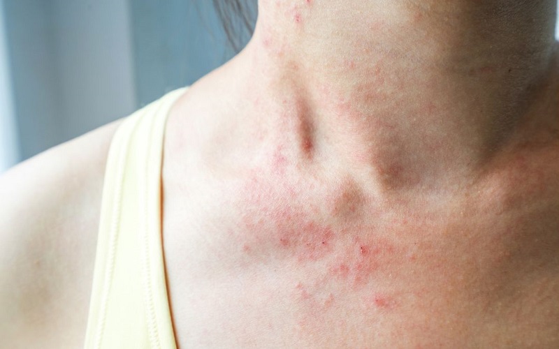 trị ngứa ngoài da