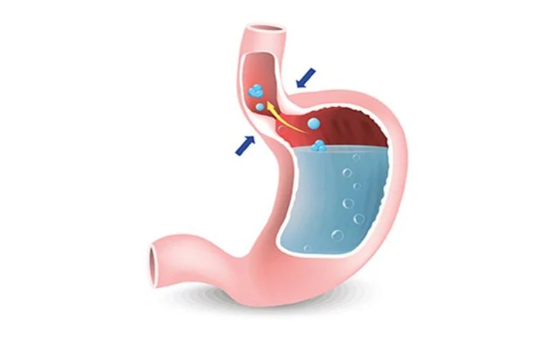 mất khả năng co bóp của thực quản khiến thức ăn ứ đọng