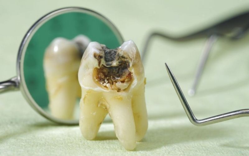 Ăn kẹo sâu răng vì sao
