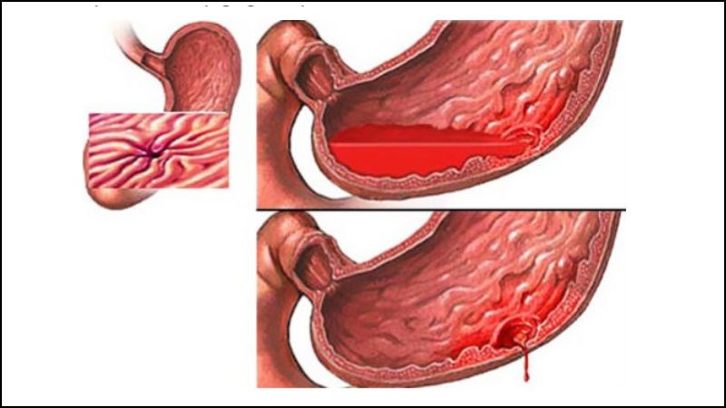 Thuốc cũng có những tác dụng phụ không mong muốn trên đường tiêu hóa hay tim mạch.