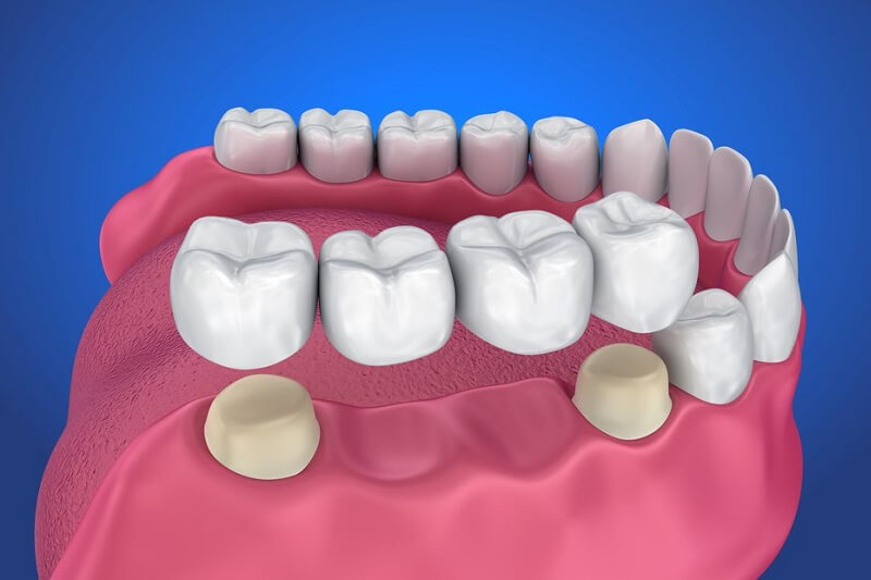 Phương pháp bắc cầu răng sứ cũng là phương án được nhiều người lựa chọn.