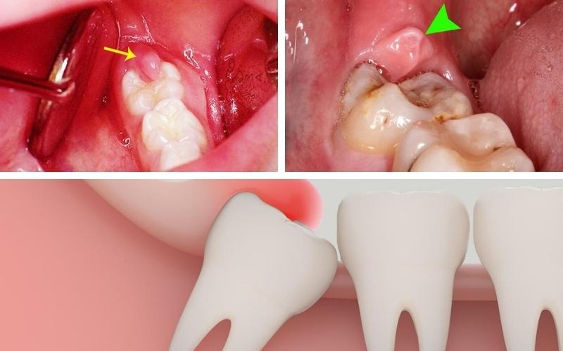 hình ảnh Bị sưng lợi hàm dưới trong cùng