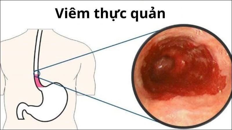Các vấn đề tiêu hóa có nguyên nhân do trào ngược