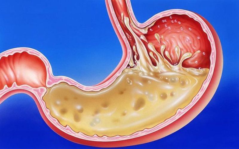 Bệnh trào ngược dạ dày-thực quản (GERD) là nguyên nhân phổ biến gây ra ợ chua, ợ nóng